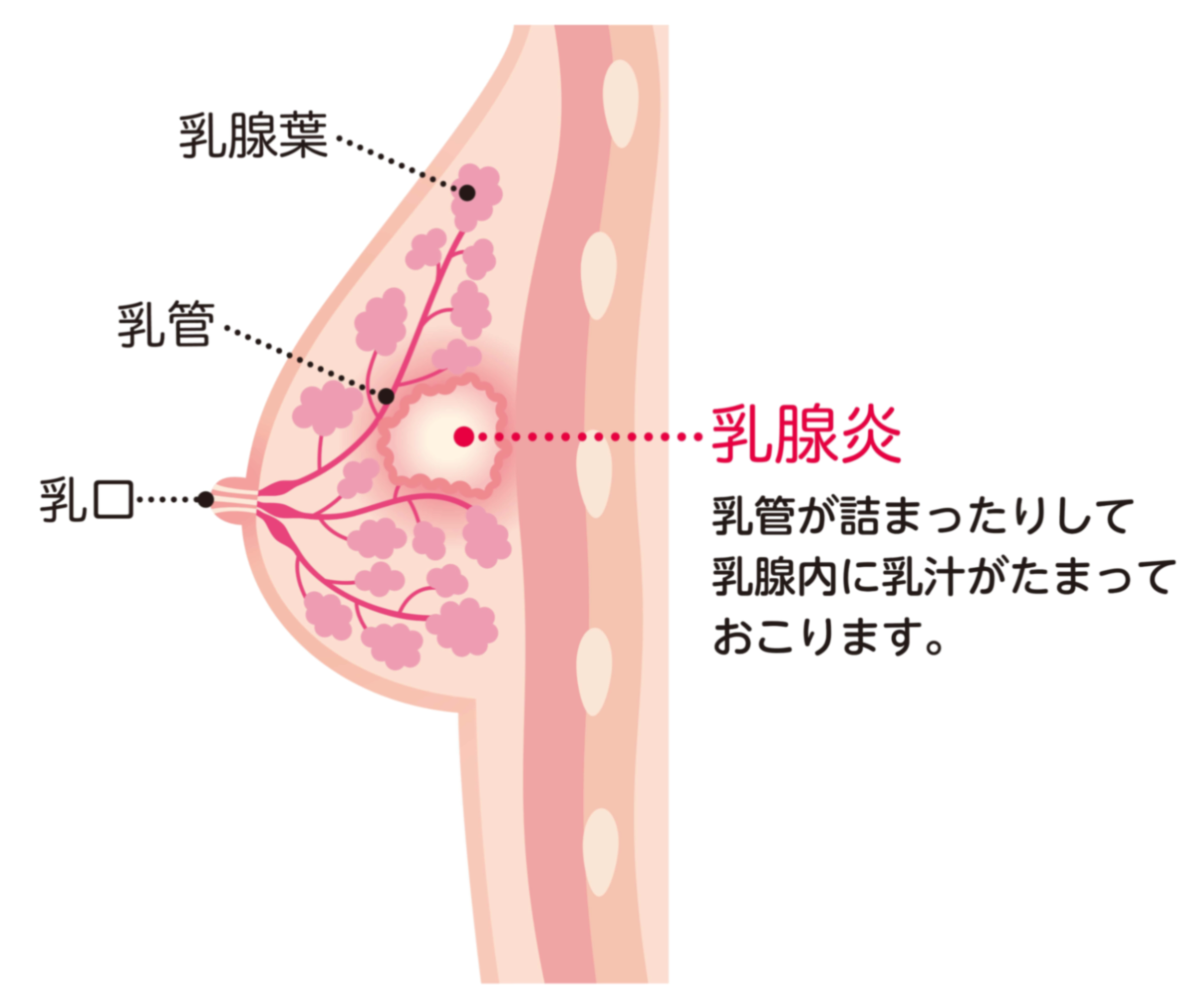 助産師監修 これって乳腺炎 乳腺炎の症状別 対処法