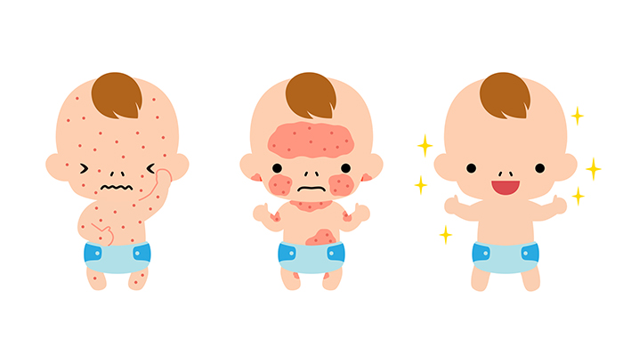 赤ちゃんの肌荒れ ニキビ 湿疹 あせも の原因と対処法